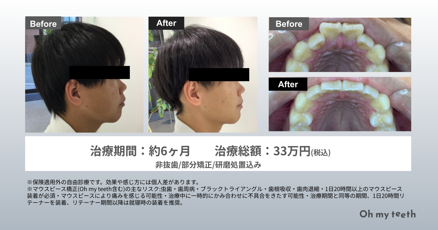 歯列矯正で顔は激変する？変化写真の真相と失敗・老け見えの境界線