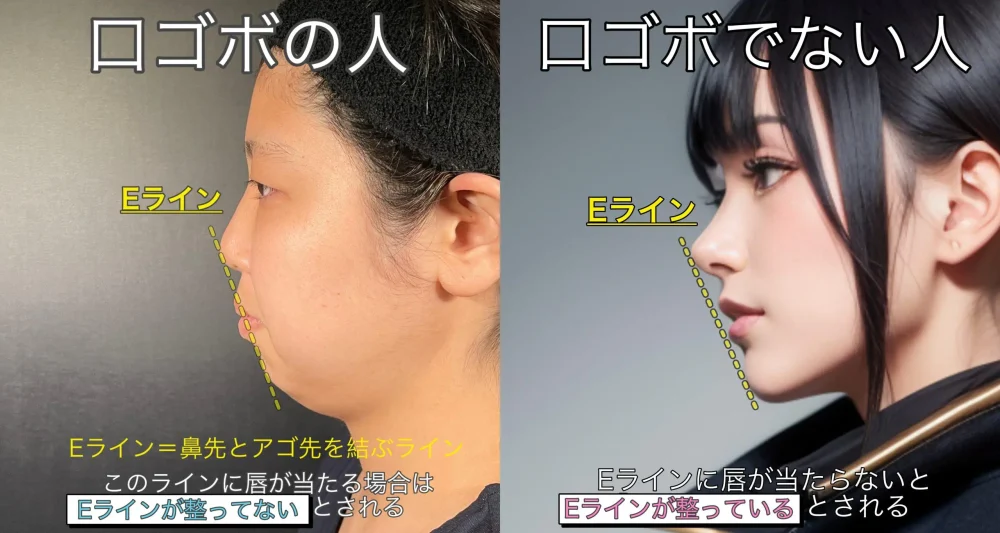 口ゴボ芸能人の垢抜け真相｜歯列矯正と骨切りで激変した理由を徹底検証