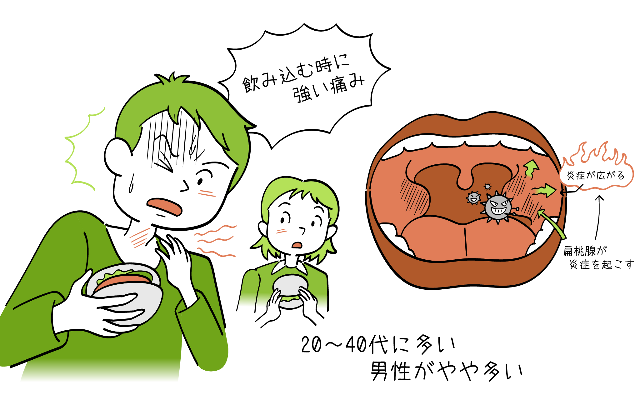 喉の激痛と口が開かない異変！扁桃周囲膿瘍とストレスの真相と入院基準