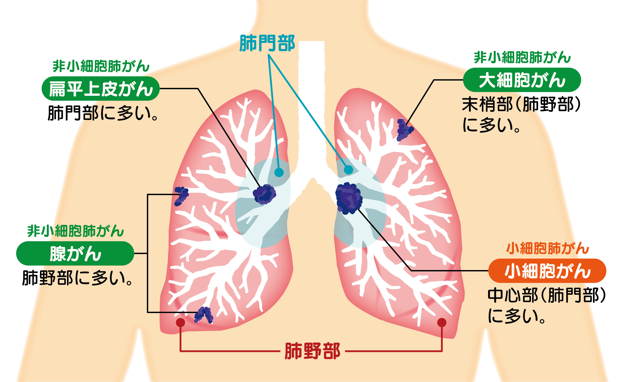 咳や風邪と放置しないで――2026年最新医療が明かす、見落とされがちな「肺がん初期症状」のリアル