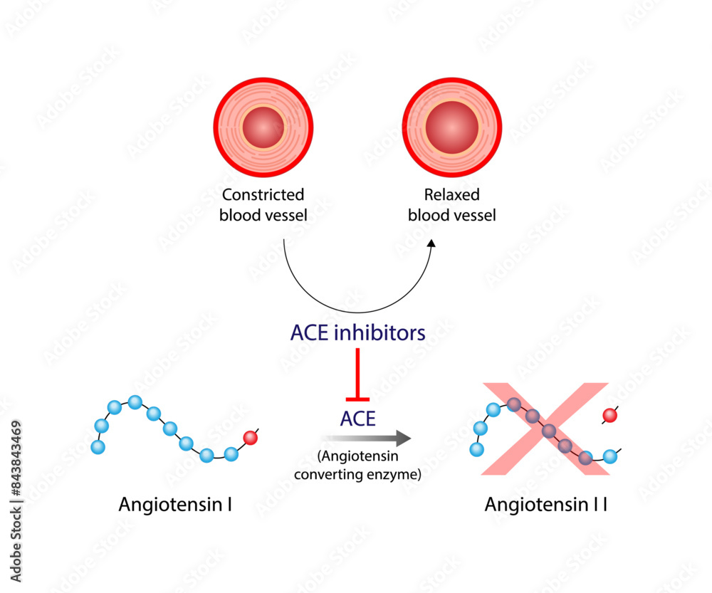What Are Ace Inhibitors