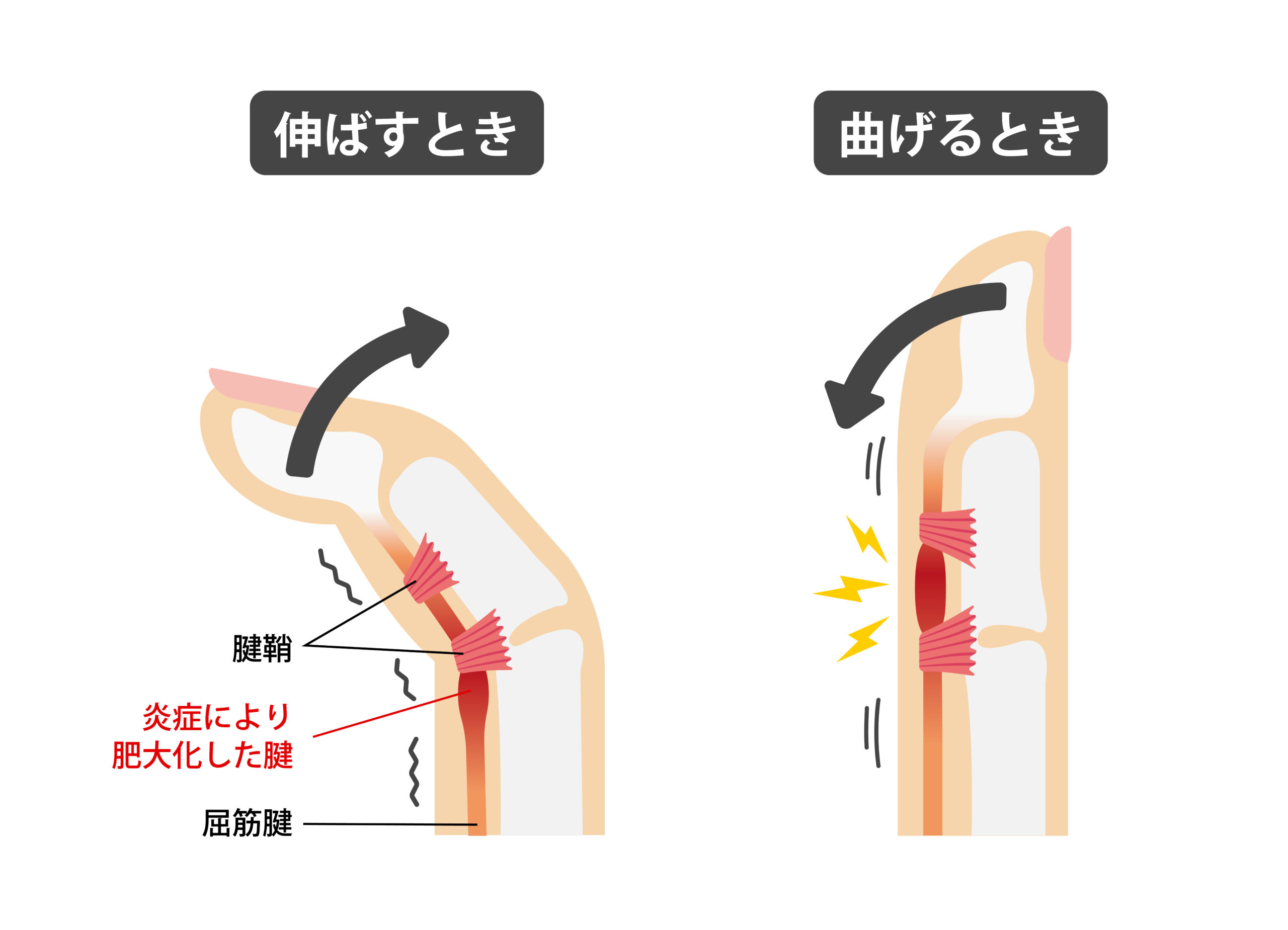スマホで指が曲がらない？ばね指の放置リスクと劇的改善ストレッチ