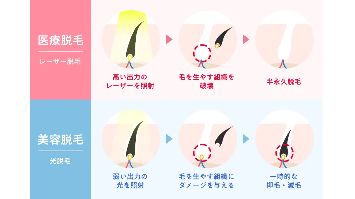 医療脱毛と美容脱毛の違いを徹底比較！後悔しない選び方と最新費用相場