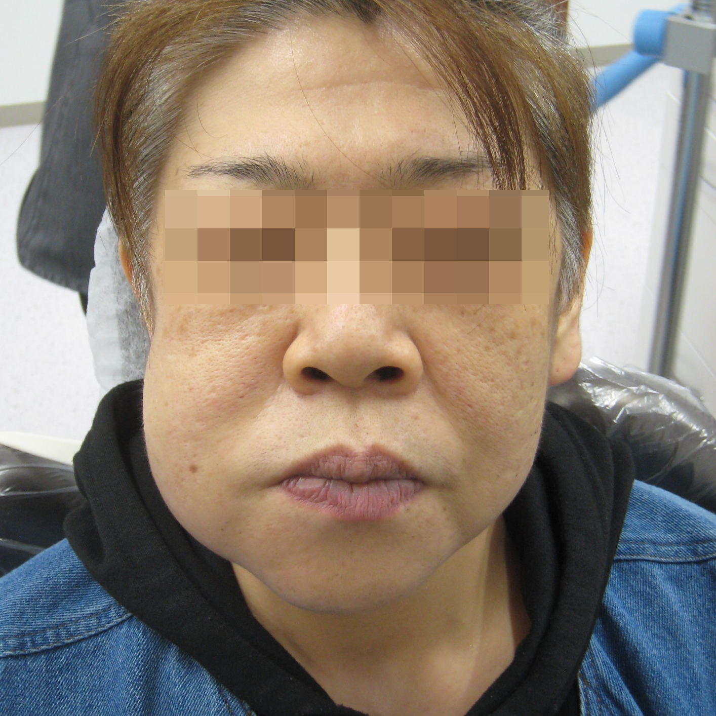 虫歯で顔が腫れる原因とは？放置厳禁の重症化サインと応急処置