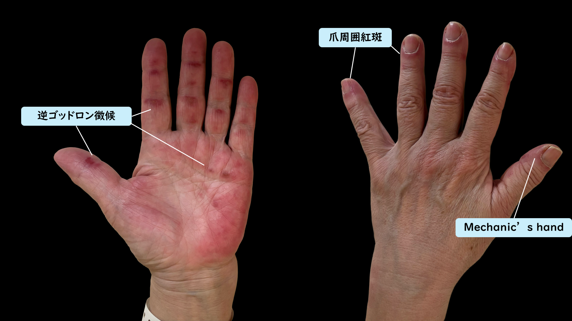 フッ化水素酸が指に付着！無痛から骨壊死に至るメカニズムと緊急対処法