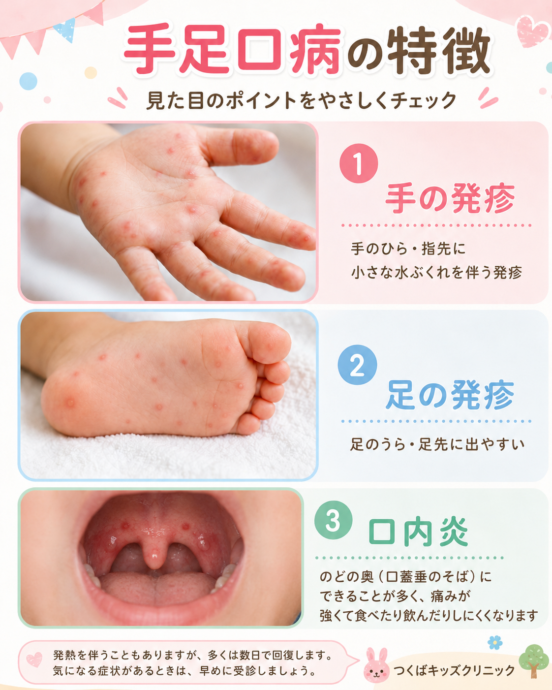 手足口病の症状に異変？大人の激痛や爪剥がれの真相と重症化対策