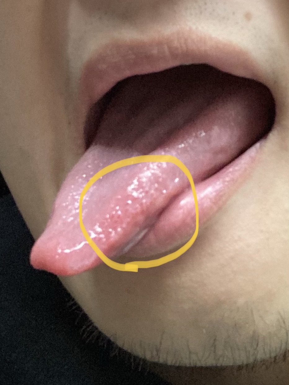 舌の横が痛い・赤い原因とは？口内炎と舌がんの見分け方と受診目安