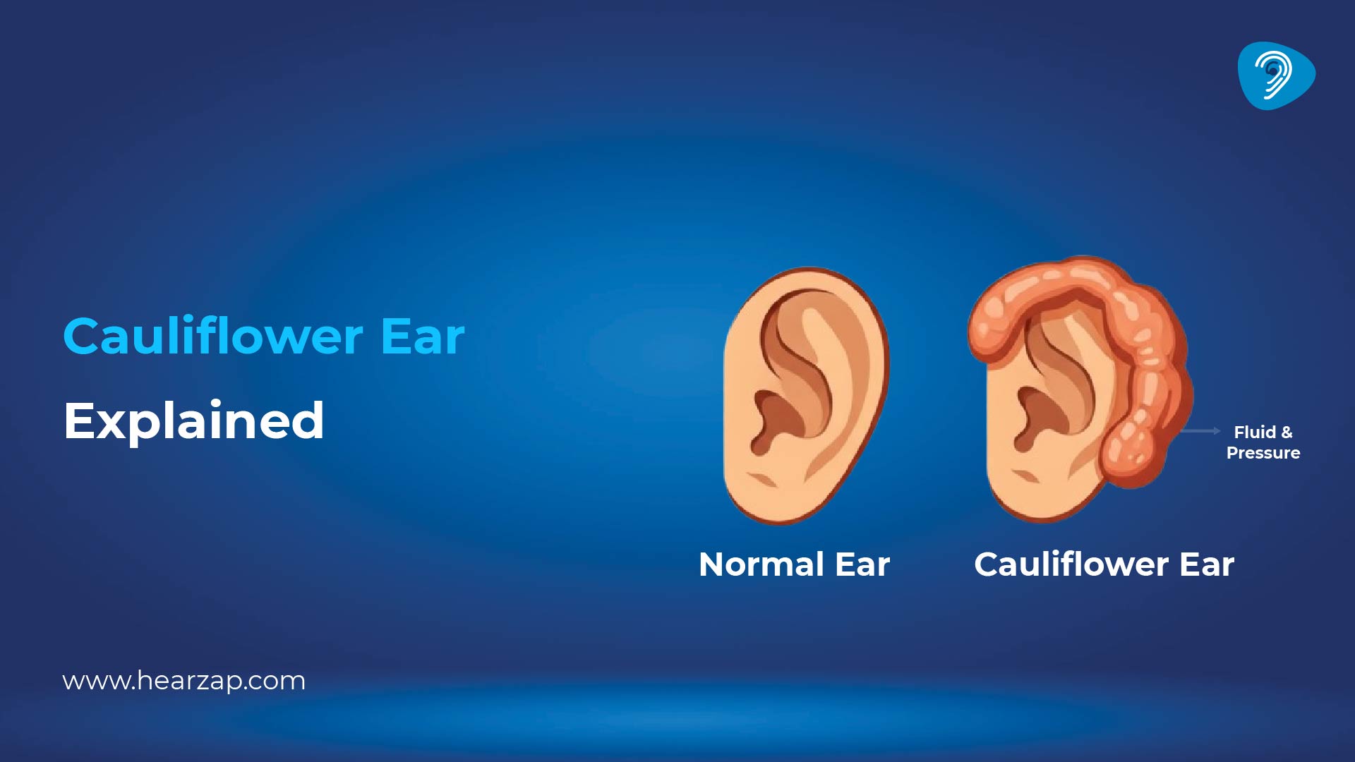 What to Do for Cauliflower Ear