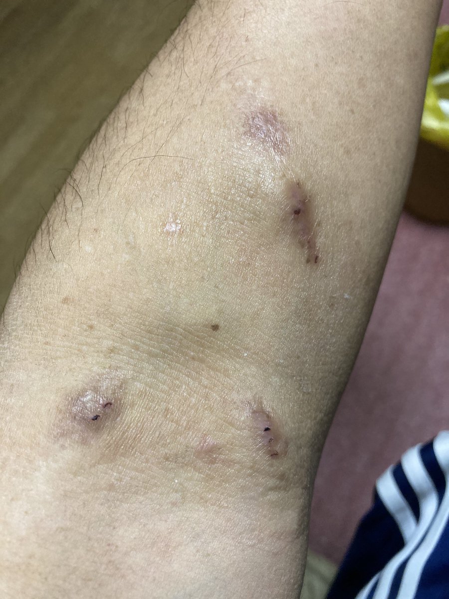 注射痕のタコ・しこりはなぜ消えない？原因と皮膚科の治し方を徹底解説