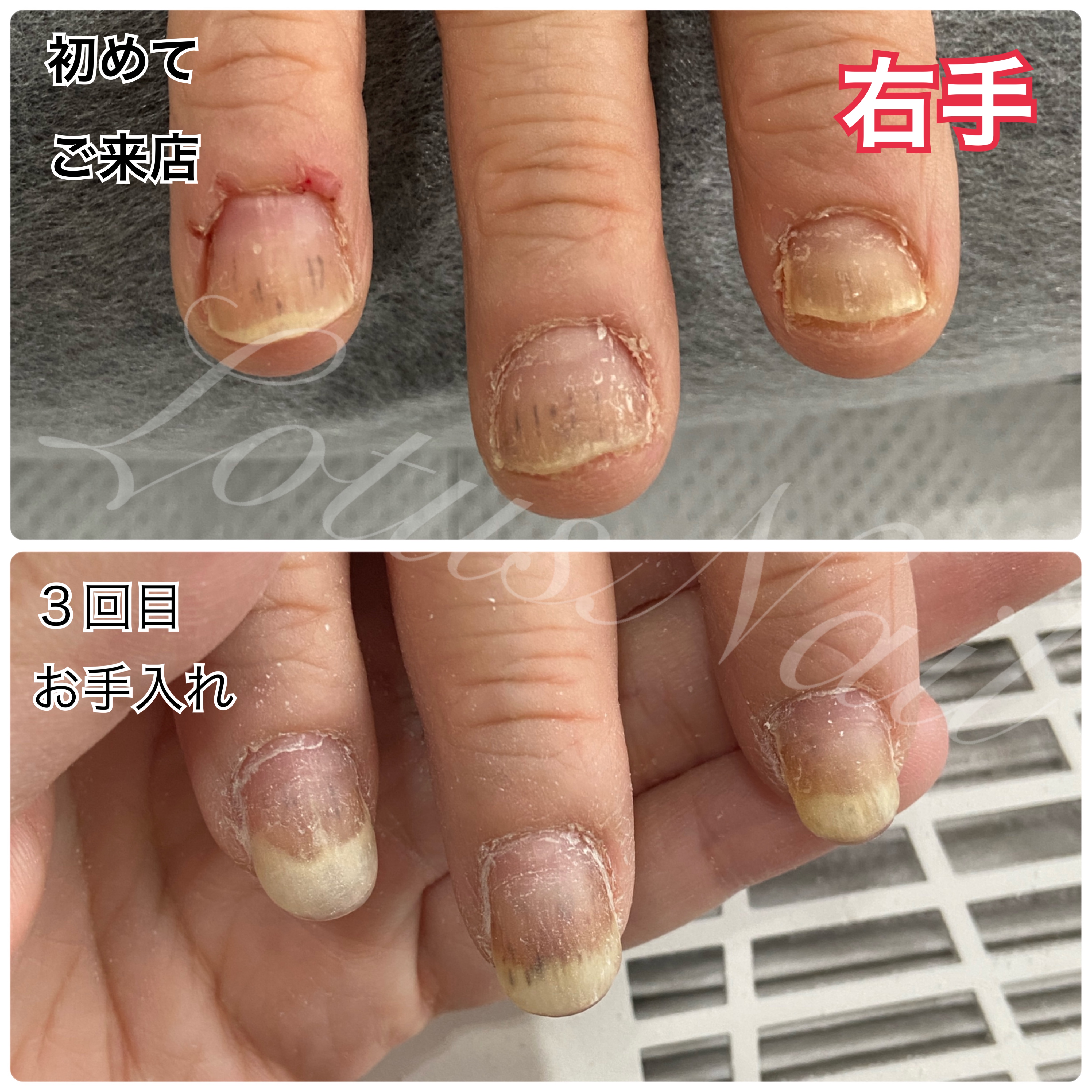 ジェルネイルアレルギーの初期症状と治し方｜原因成分と再発防止策