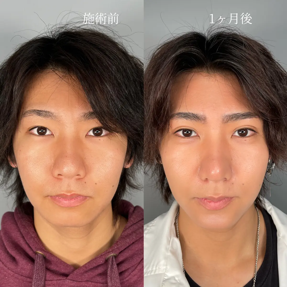 男性の整形失敗で後悔する人の共通点とは？部位別リスクと修正の真相