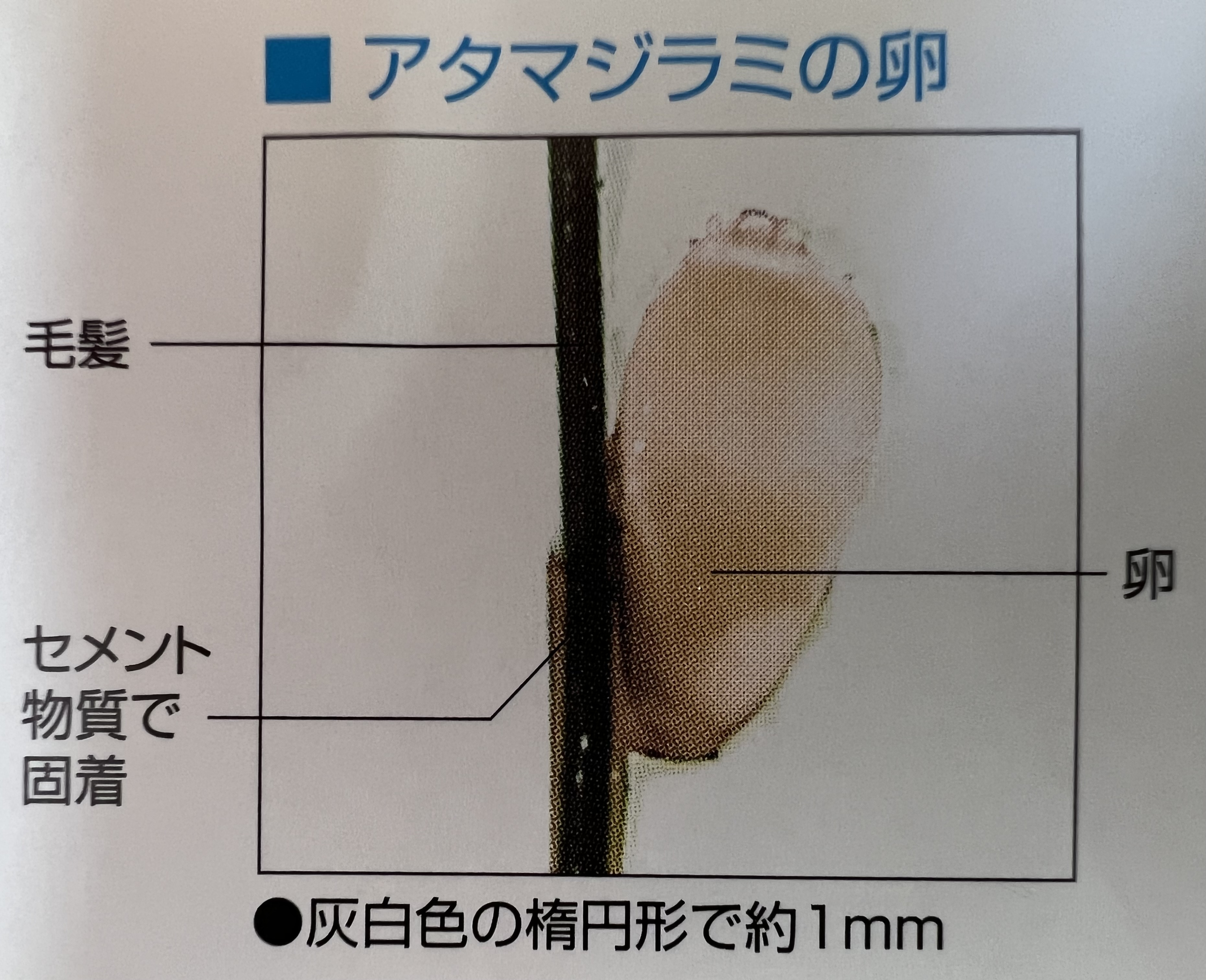 髪の白い粒はシラミの卵か？フケとの違いと2026年最新駆除法