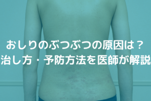 【まとめ】 おしり の ブツブツ 治す 方法 気になる噂と真相 #953