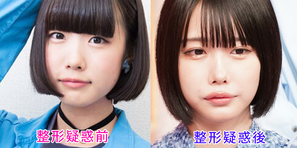 あのちゃんの顔変化を徹底検証！「整形疑惑」の真相と地下アイドル時代から2026年最新スタイルまでの自己表現史