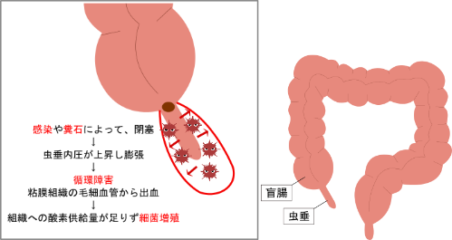 盲腸で命を落とす？虫垂炎の死亡率と手遅れになる危険な前兆を徹底解説