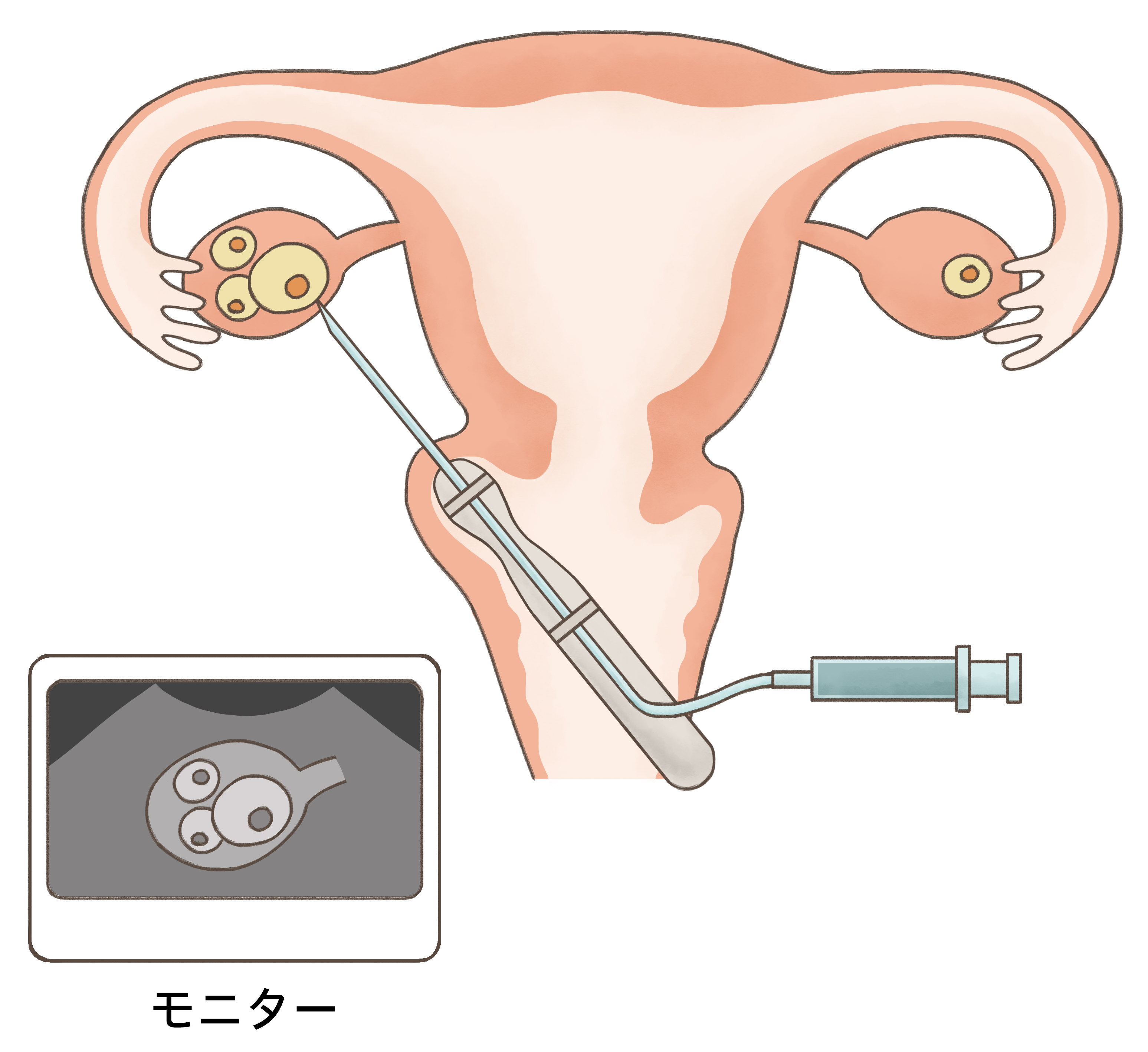 精子の正しい出し方と採取手順｜出ない原因と質を高める最新知識