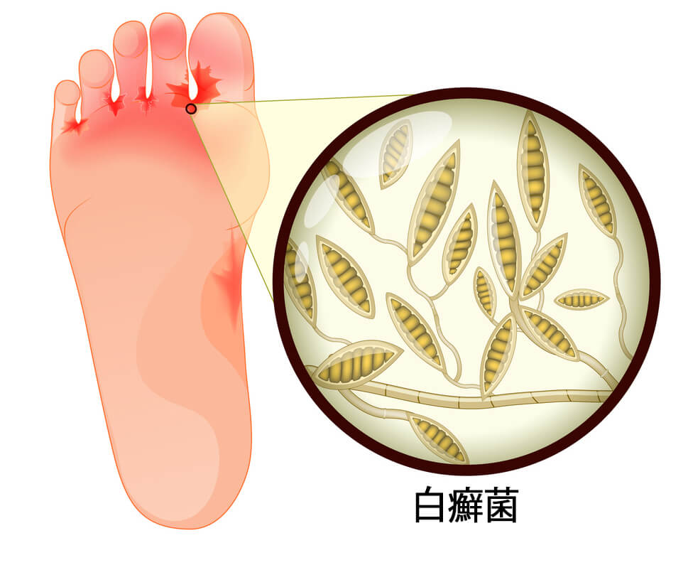 なぜ水虫は恥ずかしい？「不潔」の誤解と女性に急増する理由を解説