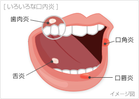 【まとめ】 口内炎 の 治し 方 裏 ワザ 話題のバズ動画・画像 #784