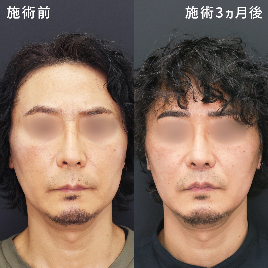 鼻の下が長い男の本性と恋愛傾向｜人相学の真実から改善策まで徹底解剖