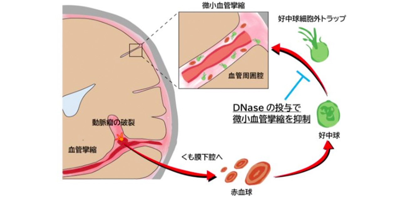 くも膜下出血後の命を脅かす「脳血管攣縮」とは？症状と最新治療