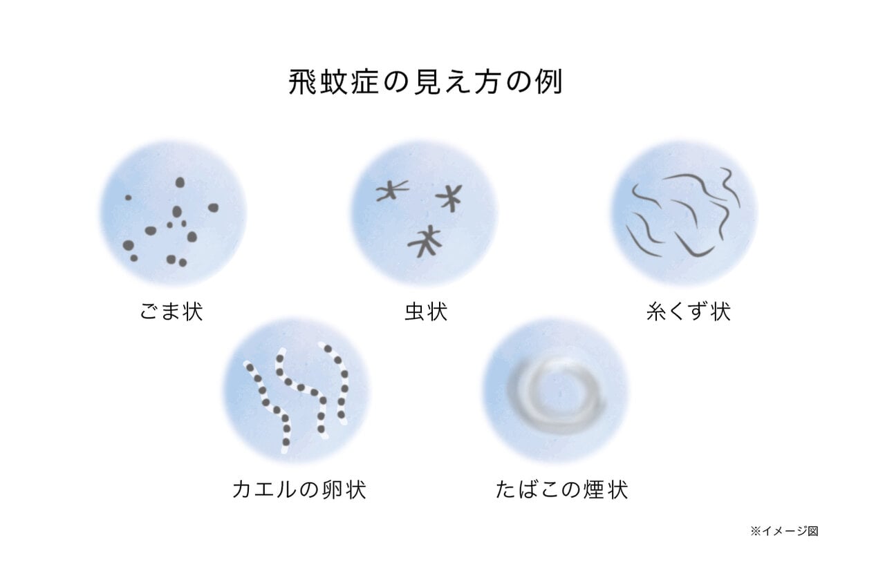 目に黒い点が1つ見える原因は？放置のリスクと受診基準を徹底解説