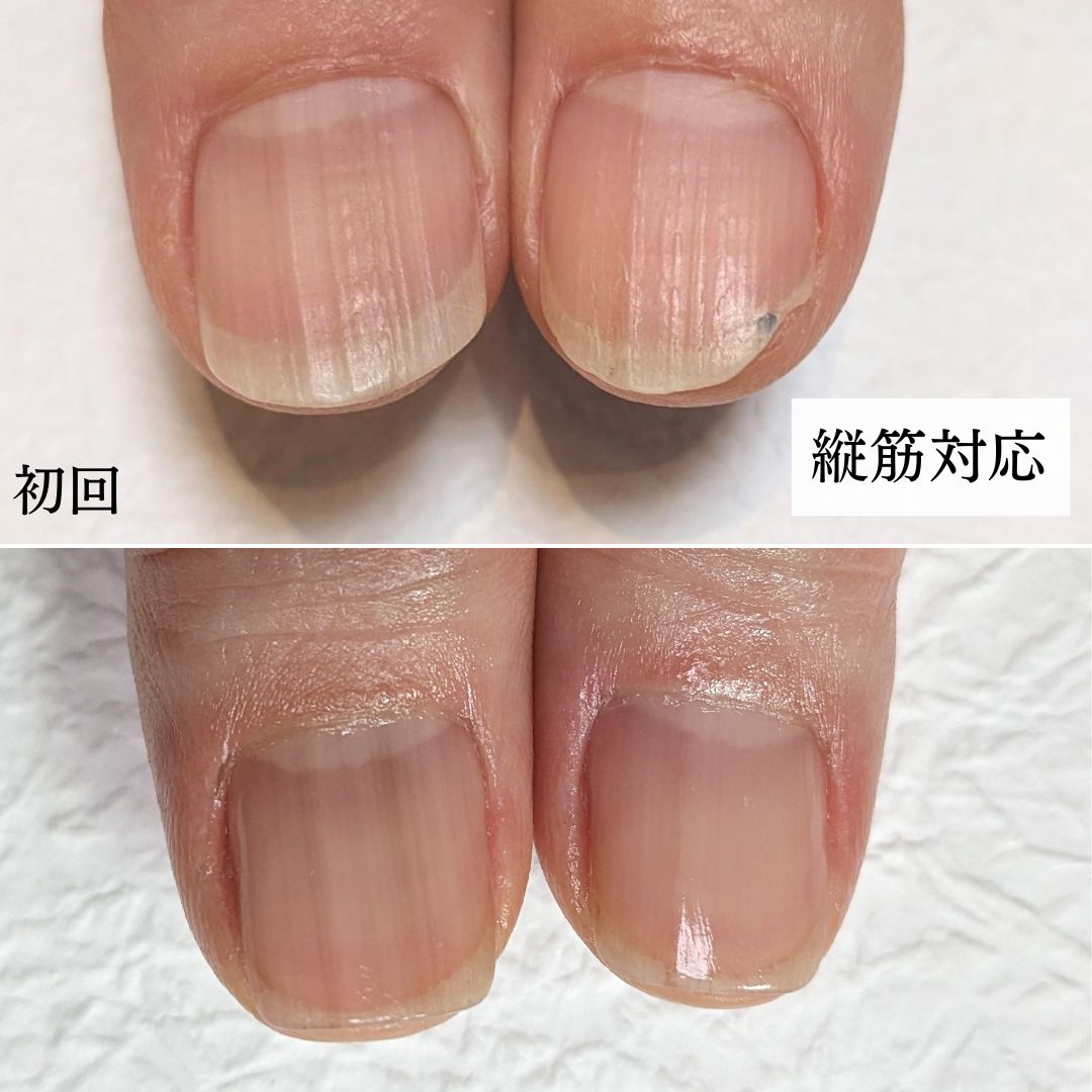 爪の縦線は老化か病気か？黒い筋やボコボコの正体と危険サイン