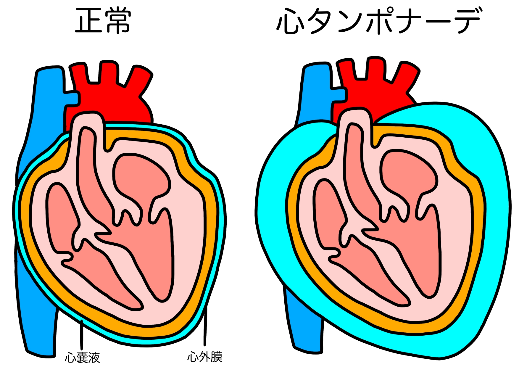 大動脈破裂で即死する真相とは？助かる確率と見逃せない前兆症状