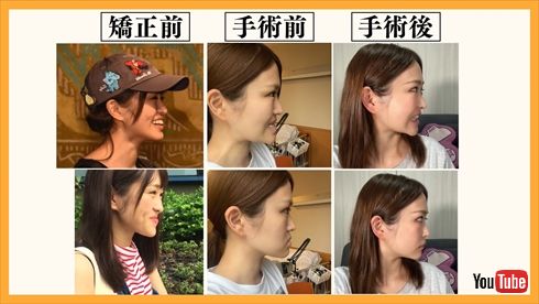 【経歴】 顎 変形 症 手術 芸能人 最新情報まとめ 2026 #942