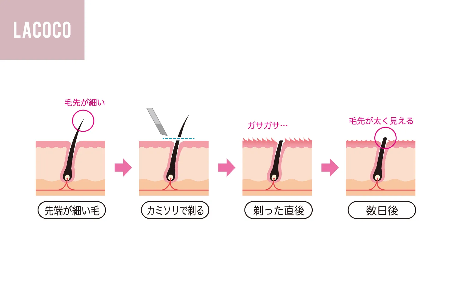 毛を剃ると濃くなる噂の真相｜皮膚科医が明かす錯覚の理由と対策
