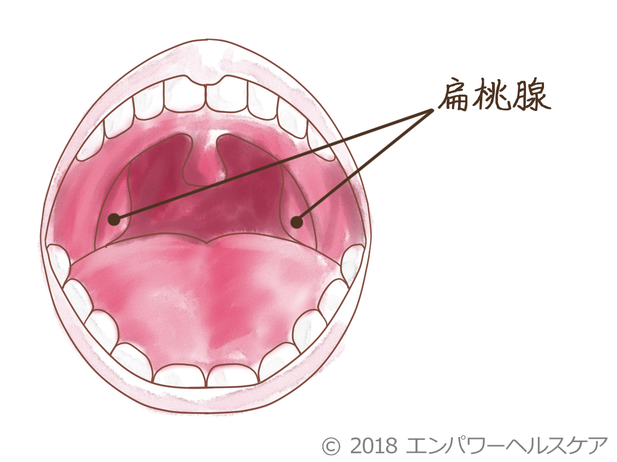 扁桃炎が一週間治らない原因とは？Ebウイルスや膿瘍の重症化リスク