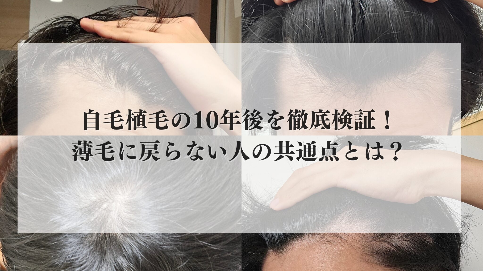 自毛植毛の10年後は悲惨？「離れ小島」の真相と後悔ゼロの維持術