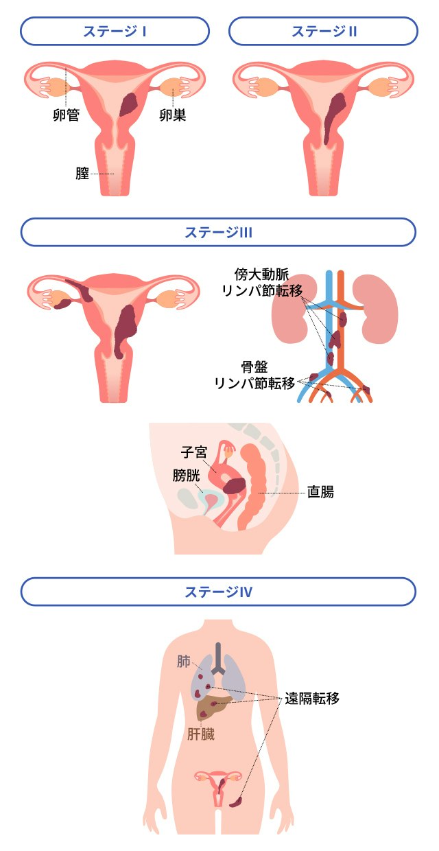 子宮体癌の進行スピードと数ヶ月で悪化する噂の真相【2026年最新】