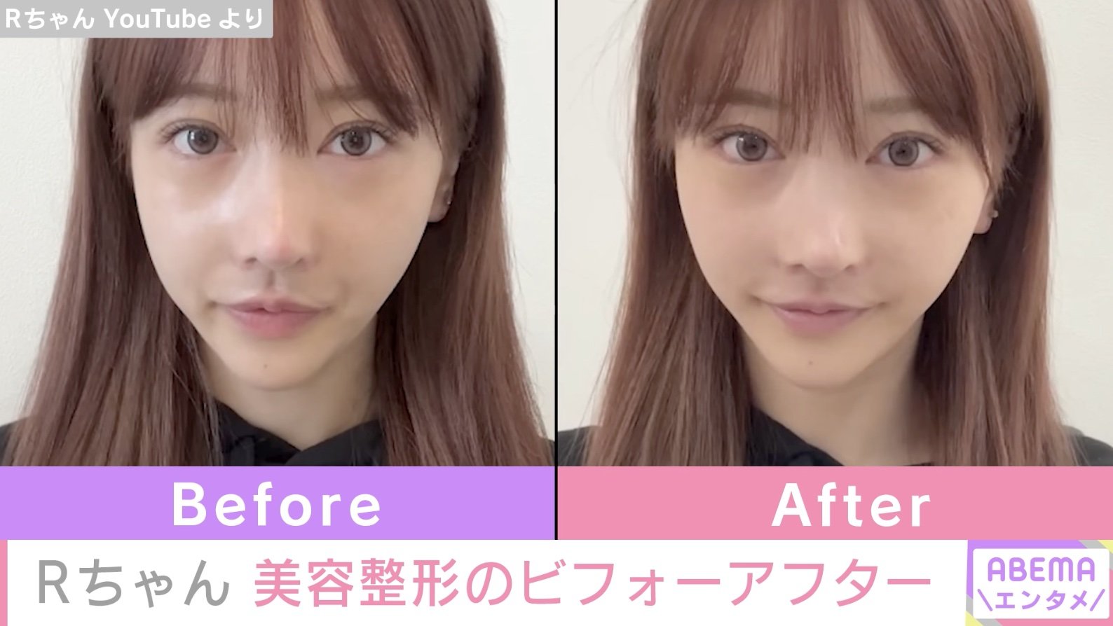 Rちゃんの整形前と現在を徹底比較！施術箇所とダウンタイムの真相
