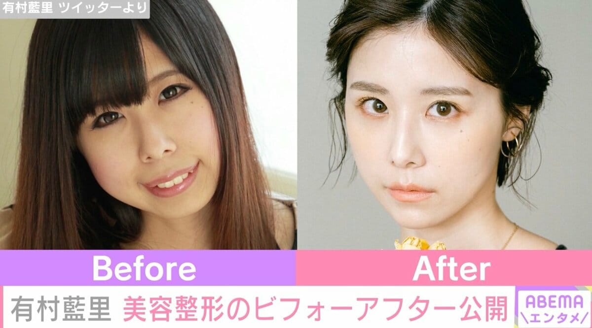 有村藍里が骨切り告白で掴んだ光と現在地！容姿の呪縛を解いた記録