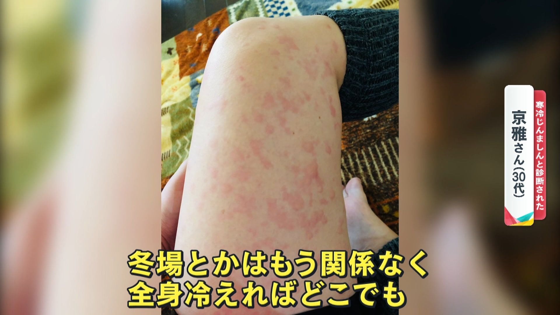 寒暖差アレルギーと蕁麻疹の違いは？かゆみ・腫れの正体と最新対処法