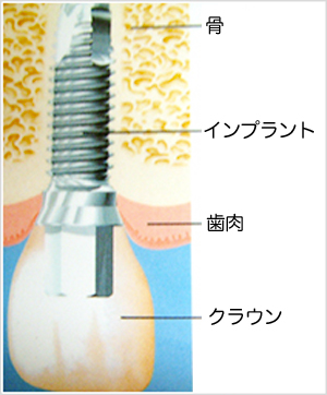 【動画まとめ】 吉田正尚 歯 インプラント 最新写真集＆動画まとめ #635