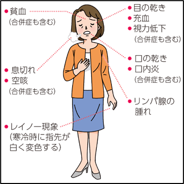 「膠原病には美人が多い」という言説は本当か？2026年の医療現場とSnsから紐解く、美しき誤解の真実