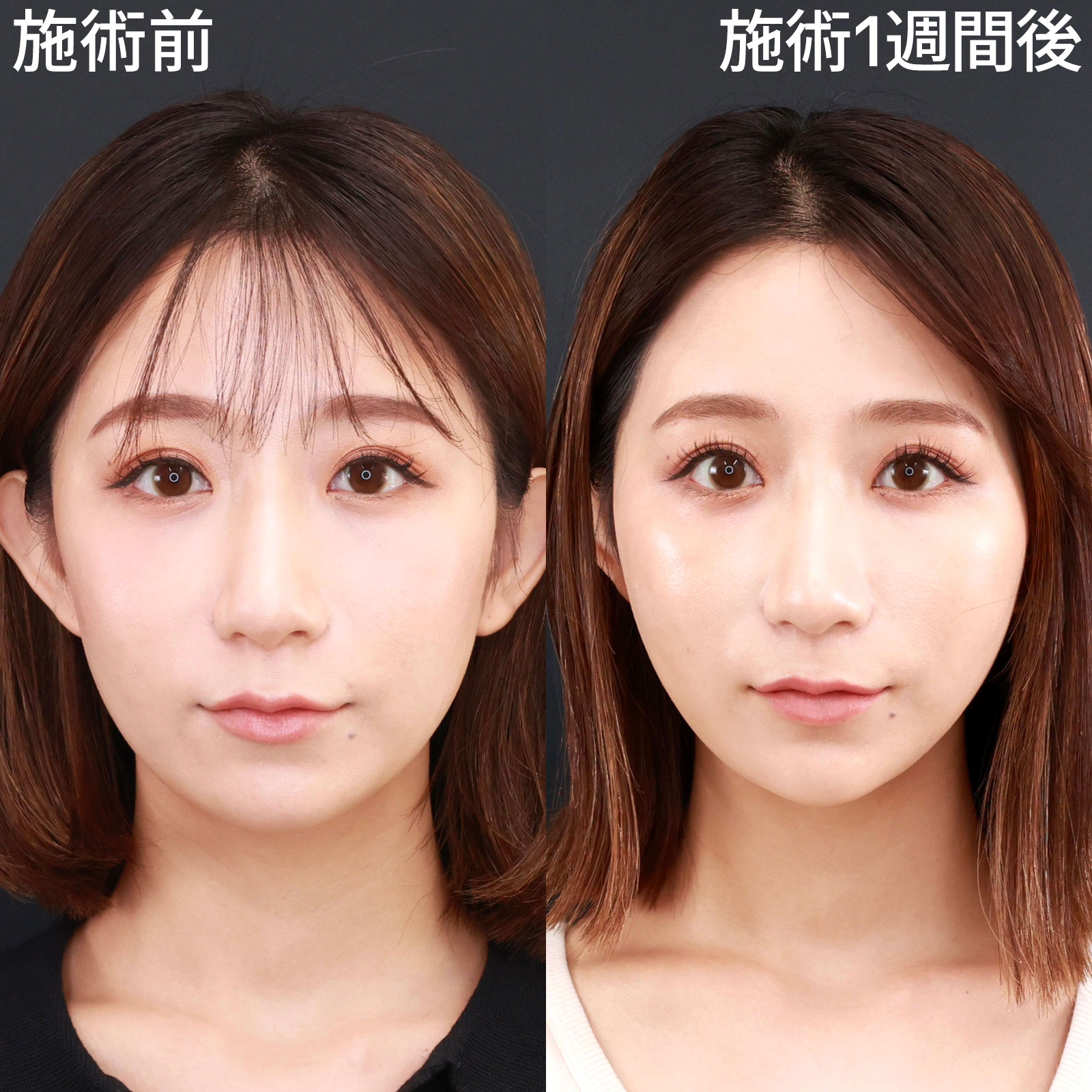 ゴルゴ線ヒアルロン酸は逆効果？失敗の真相と後悔しない名医の選び方