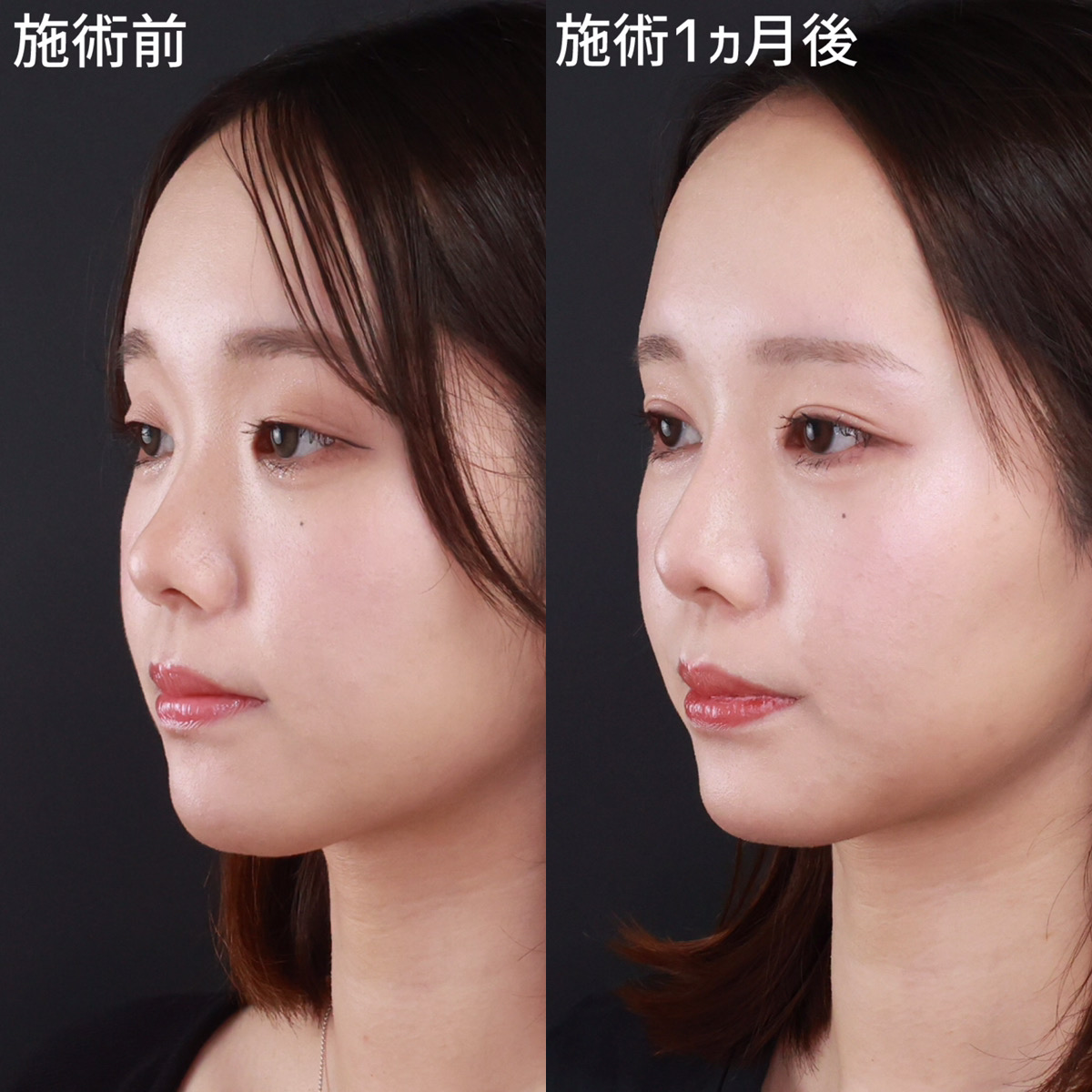 整形バレバレ芸能人の顔変化を徹底検証！不自然さの真相と最新事情