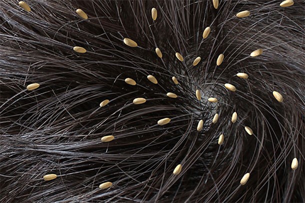 Pictures of Nits in Blonde Hair