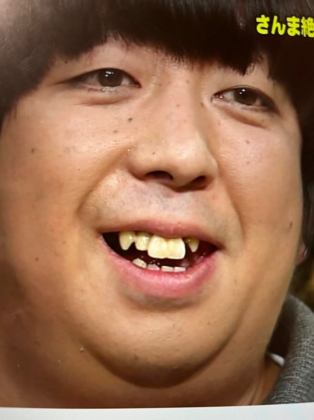 バナナマン日村の歯が劇的変化！総額500万円インプラントの全貌