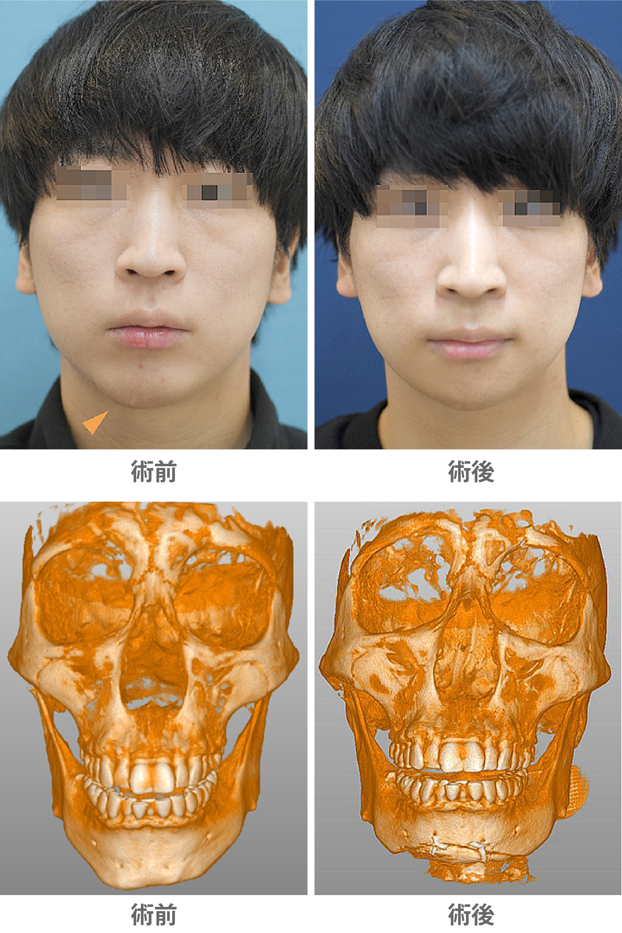 顎が大きい原因と最新美容医療の真実！芸能界が注目する意外な利点
