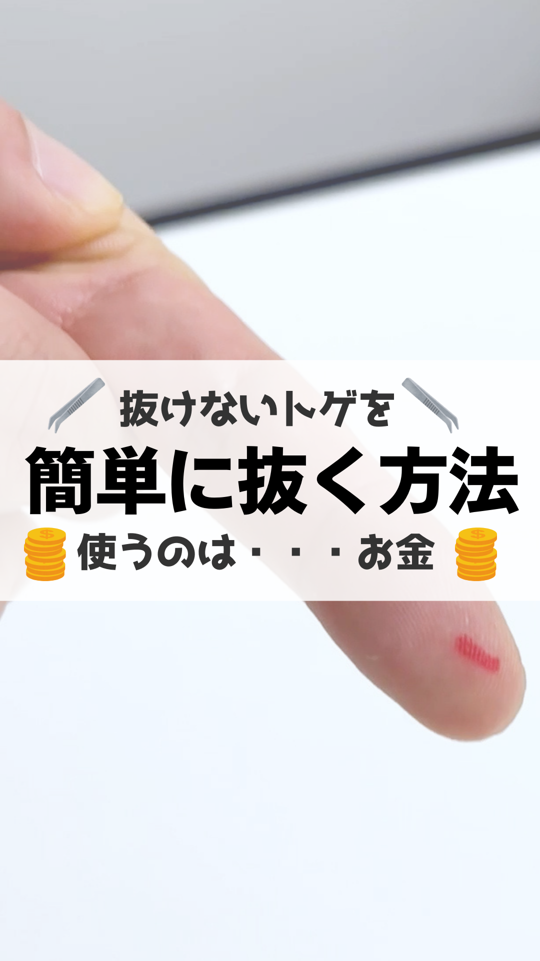 トゲが取れない！無理にほじくる危険性と痛くない裏ワザ＆受診目安