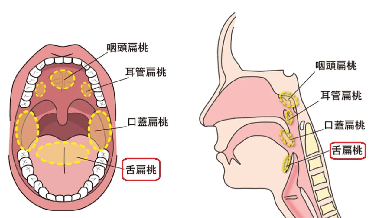 舌の奥のブツブツは病気？正常な組織と舌がんの決定的な見分け方