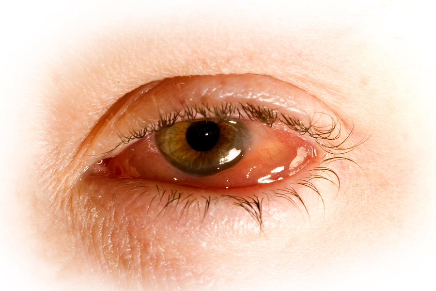 Can Mold Cause Pink Eye